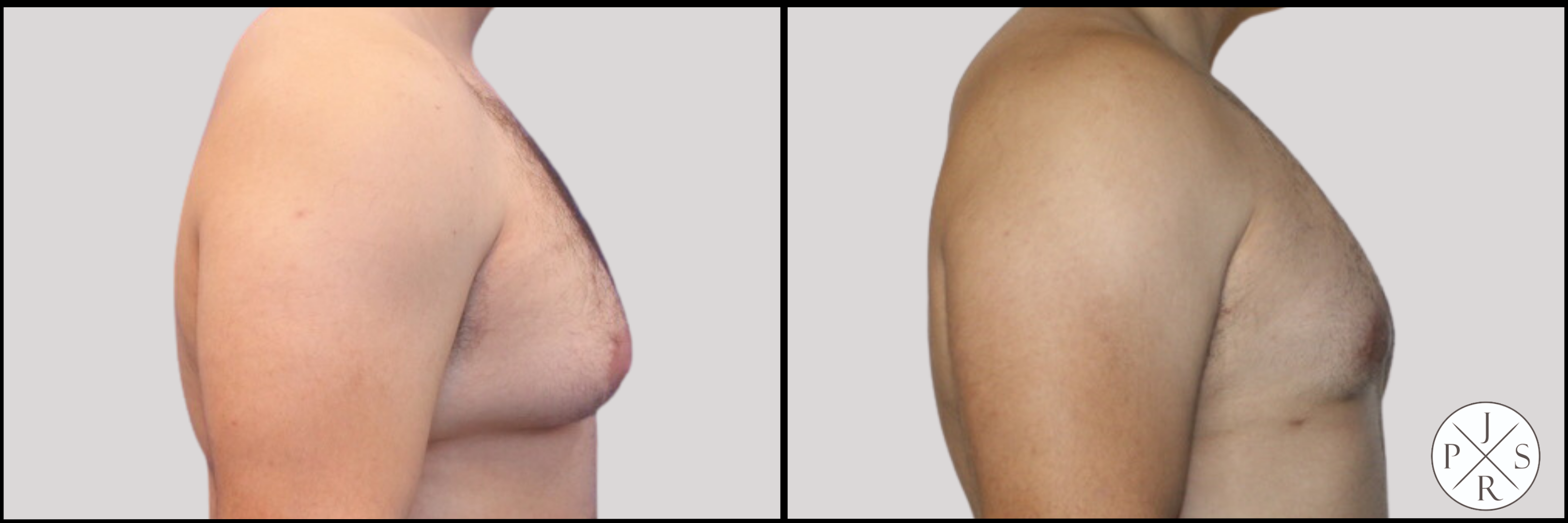 Gynecomastia Before & After Image